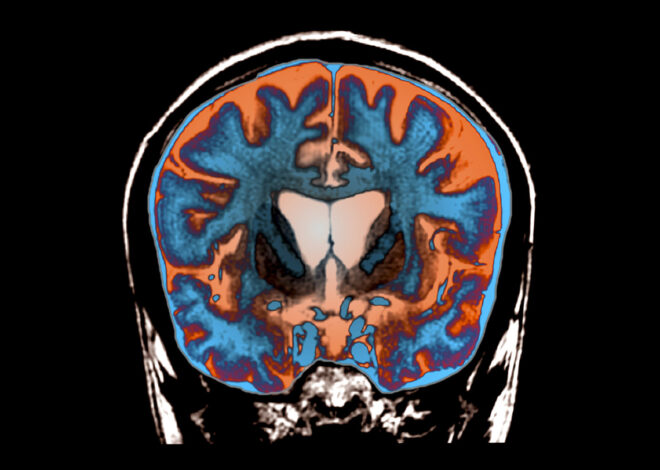 Groundbreaking Experimental Treatment Slows Progression of Huntington’s Disease