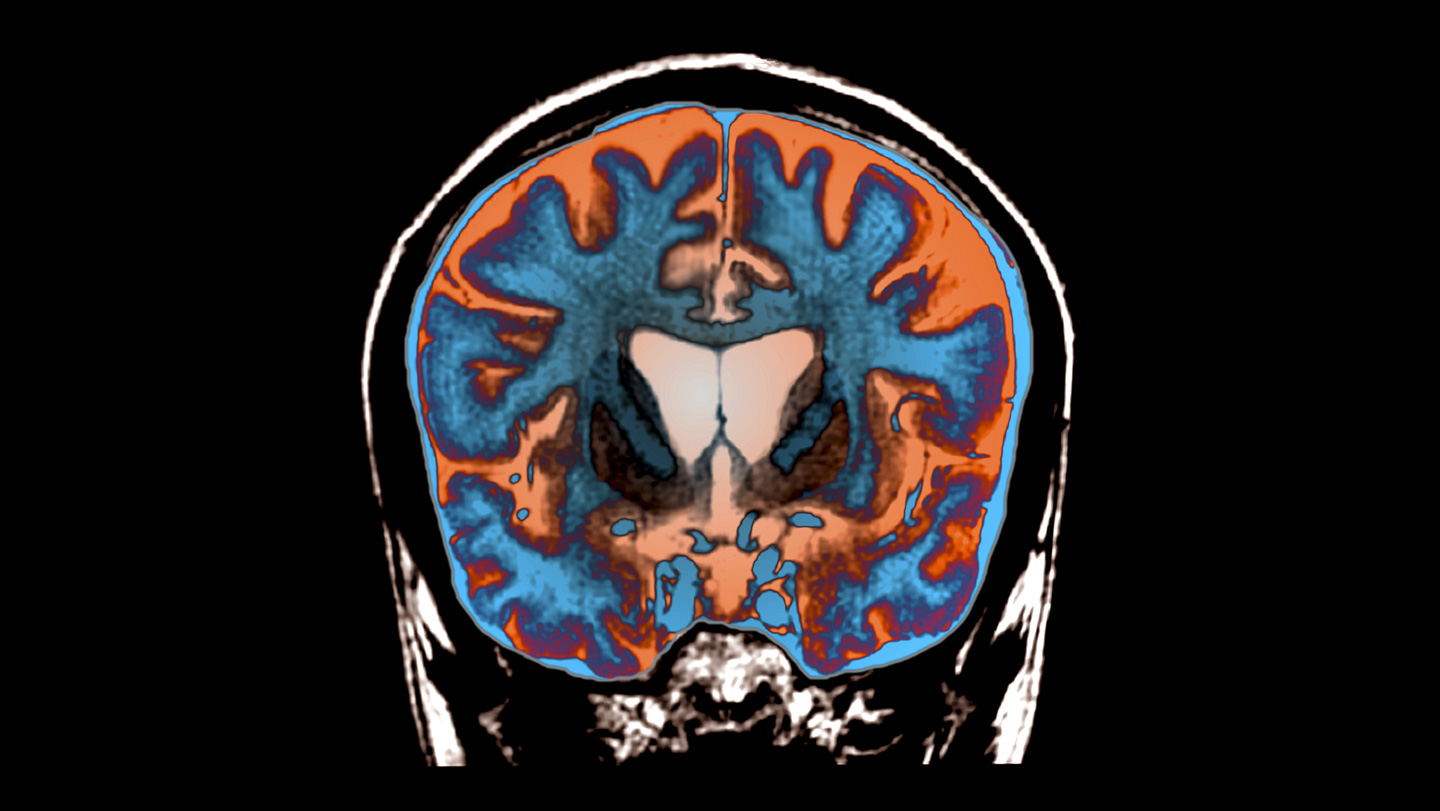 Groundbreaking Experimental Treatment Slows Progression of Huntington’s Disease