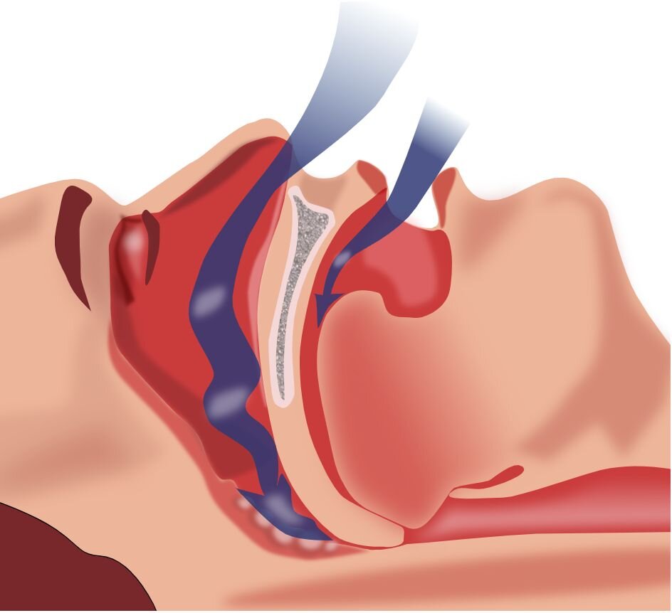 Breathing device could have profound impact on survival for people with sleep apnea and type 2 diabetes