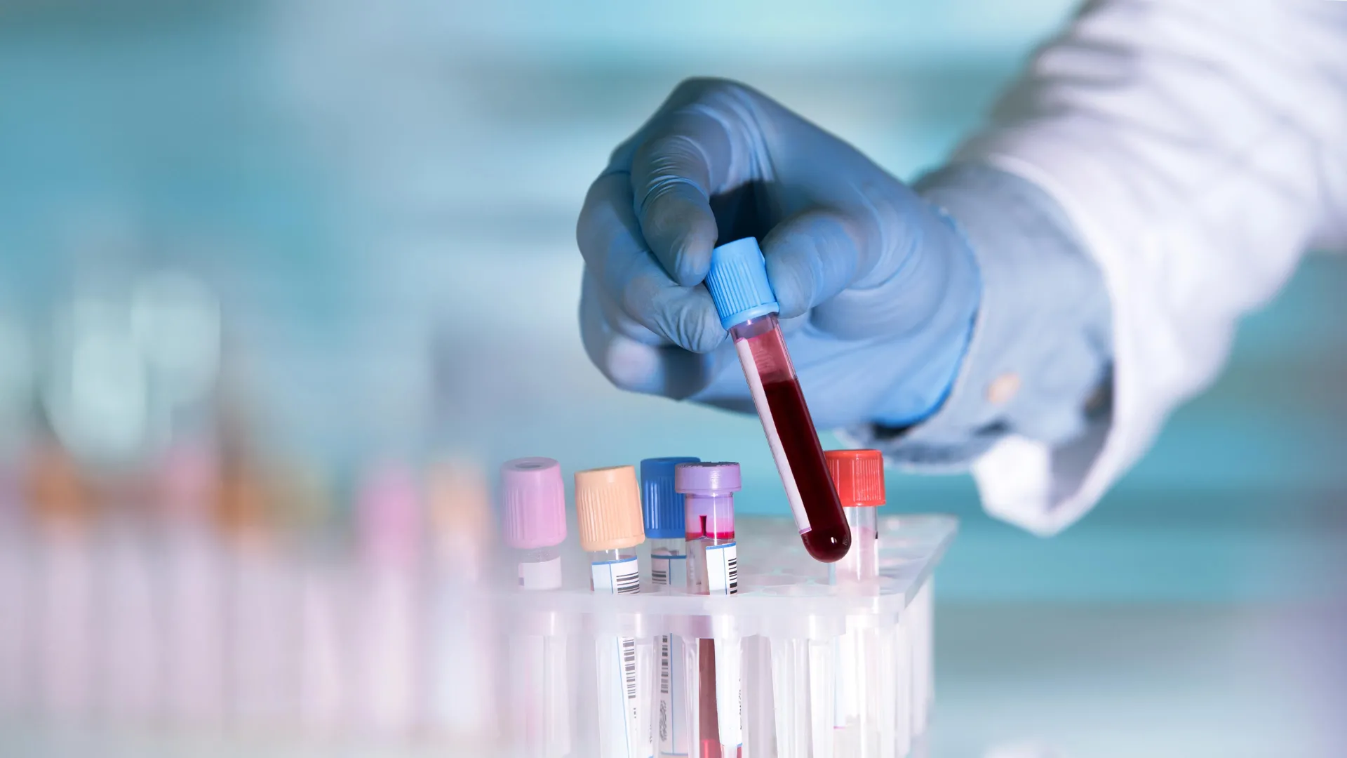Simple blood test could spot Alzheimer’s years before symptoms
