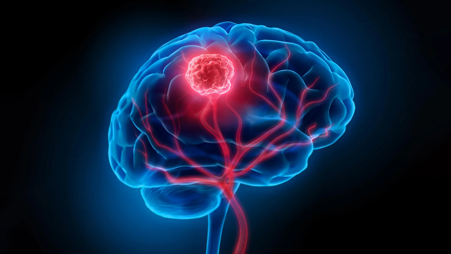 Mapping the secret escape routes of deadly brain tumors