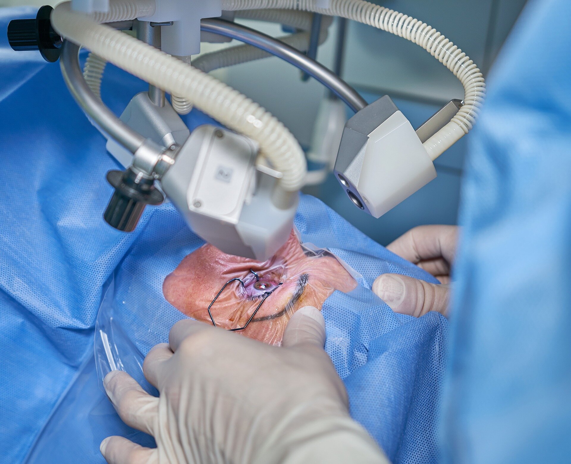 Cataract surgery on both eyes can be carried out safely and effectively in one go, studies indicate