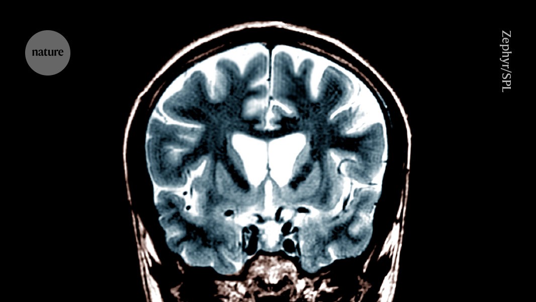 First Successful Gene Therapy Treatment for Huntington’s Disease