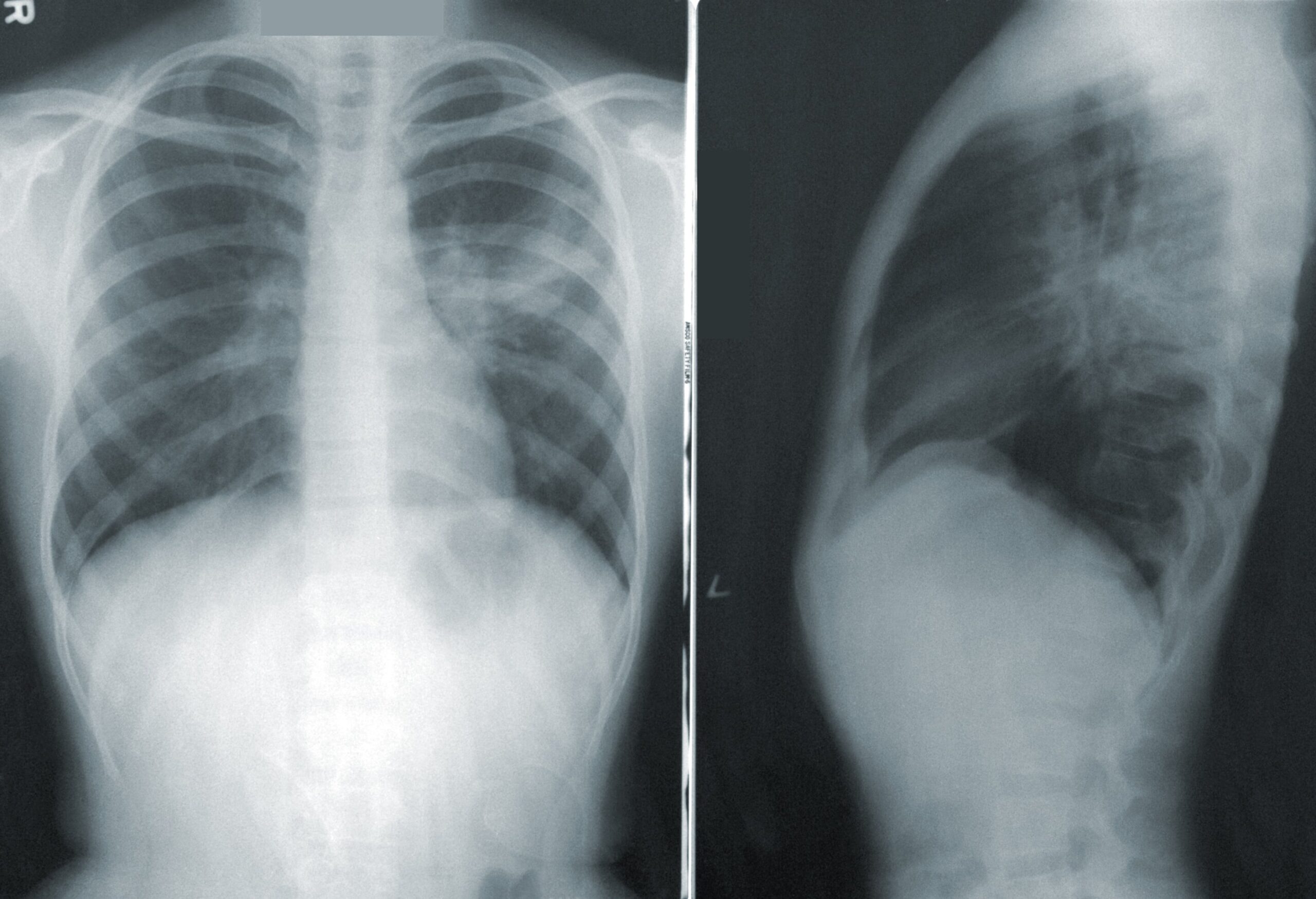 Iza-bren and osimertinib combination shows 100% response rate in EGFR-mutated lung cancer