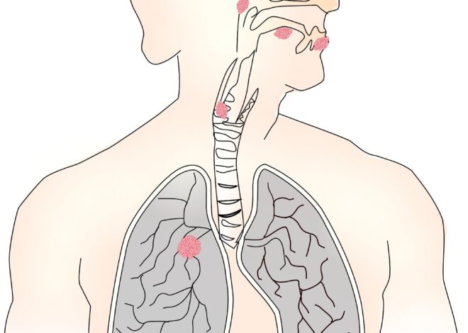 Lung cancer screening benefits adults up to age 80 if surgical candidates, UK study finds