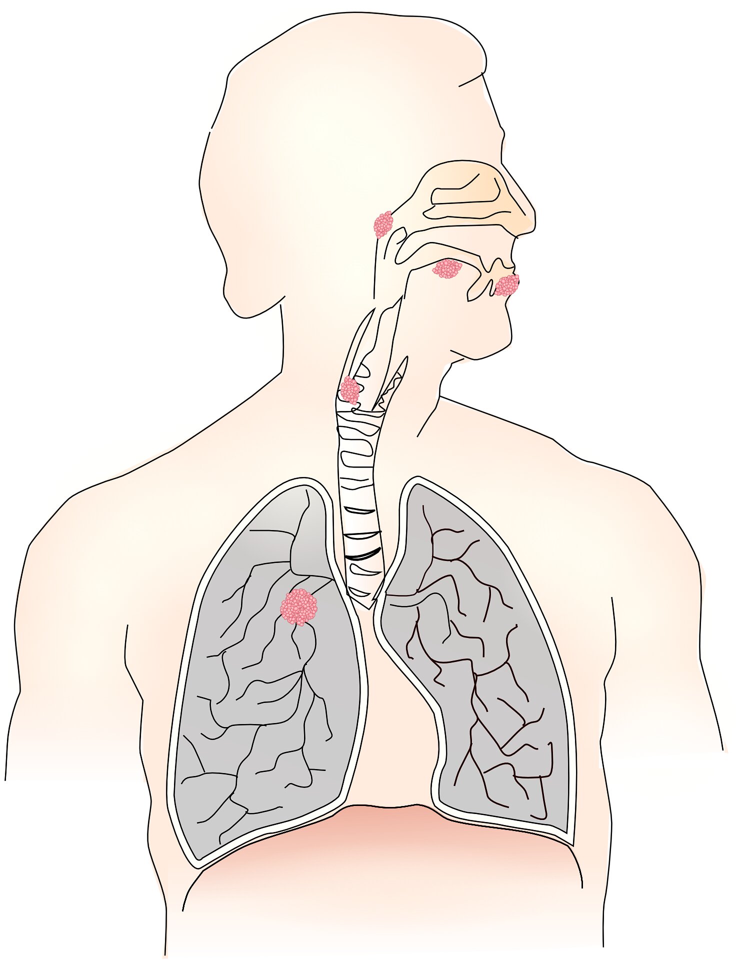Lung cancer screening benefits adults up to age 80 if surgical candidates, UK study finds