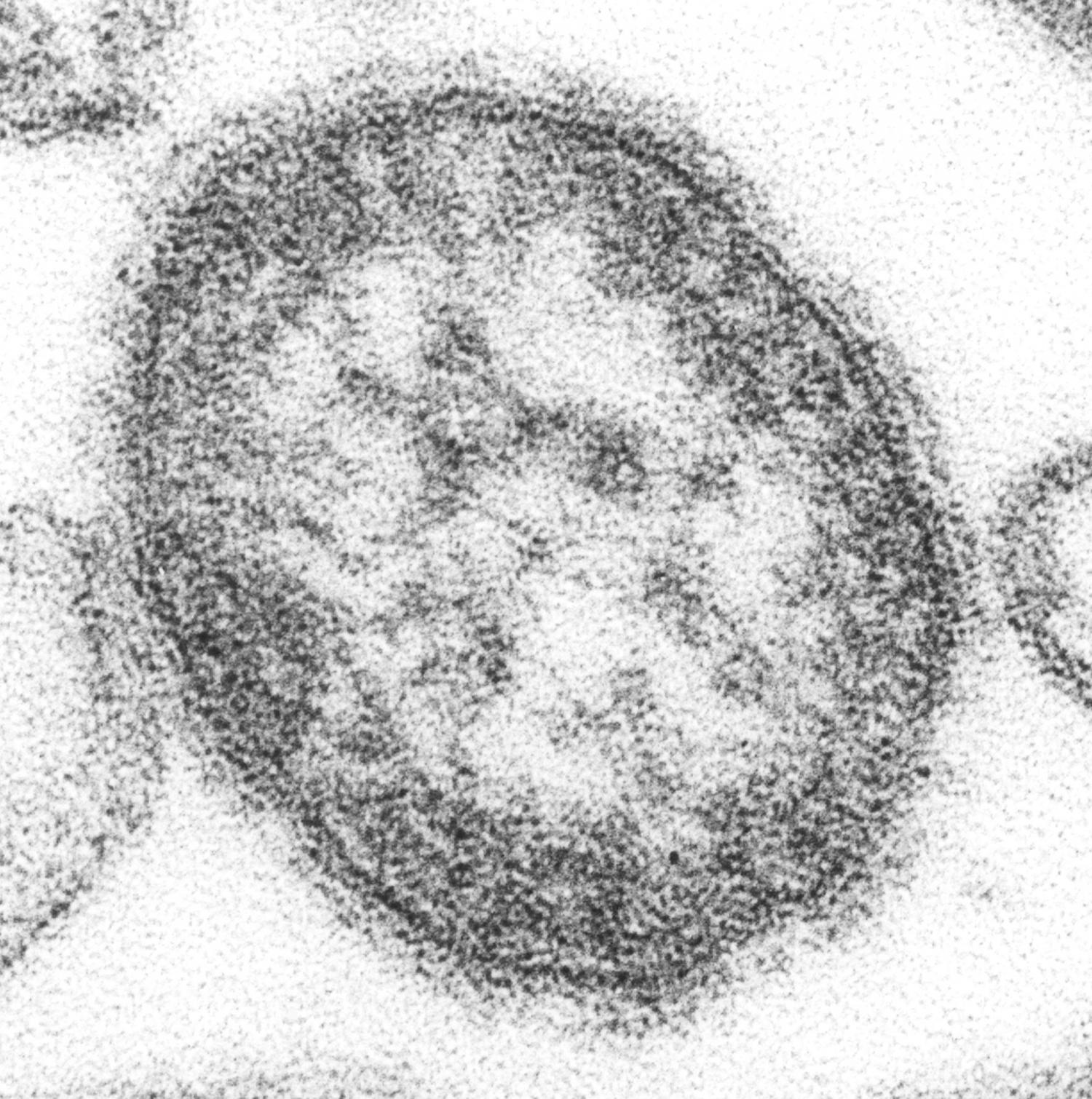 Child dies from complication of measles contracted years earlier