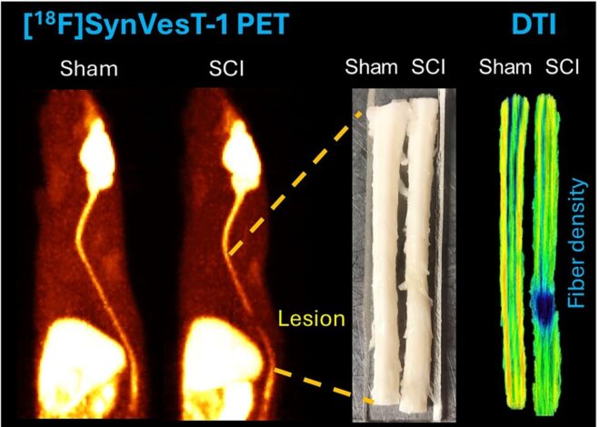 Novel PET tracer detects synaptic changes in spinal cord and brain after spinal cord injury