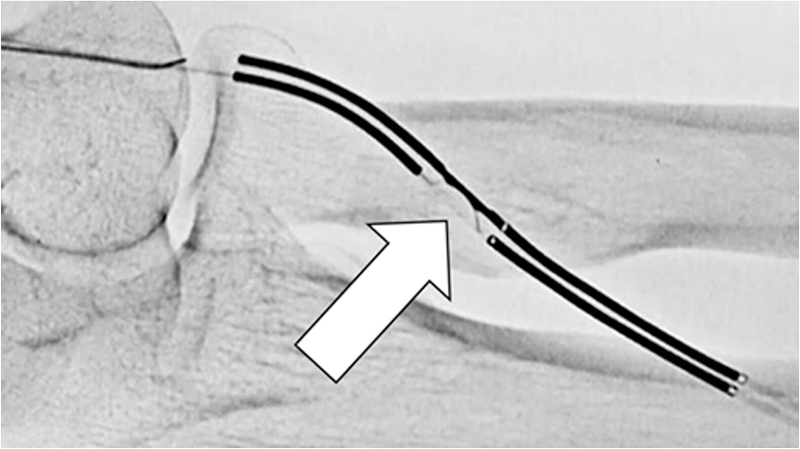 Practice guidance for percutaneous arteriovenous fistulas for dialysis access